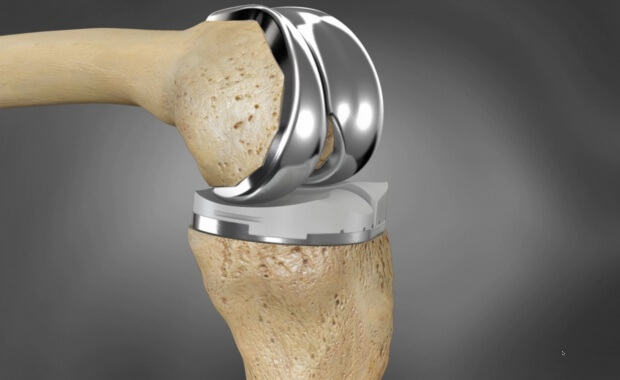 Simulação de prótese cirúrgica de polietileno aplicada em uma articulação humana.